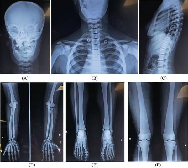 Skeletal survey in six panels, A to F: frontal skull, neck and clavicles, lateral spine, forearms and hands labelled L and R with arrows at the digit tips, legs and feet, and femora and knees