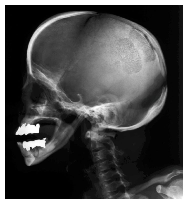 Lateral skull radiograph showing a markedly obtuse mandibular angle and a gap in the vault near the vertex