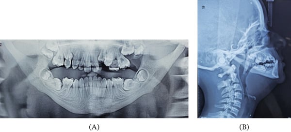 Panel A, panoramic dental radiograph with crowded teeth; panel B, lateral cephalometric radiograph