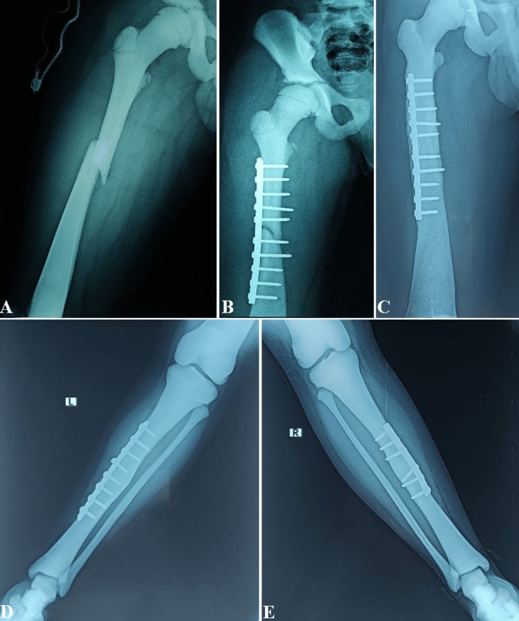 Panel A, femoral shaft fracture; panels B and C, the femur after plate fixation; panels D and E, left and right tibiae with plates