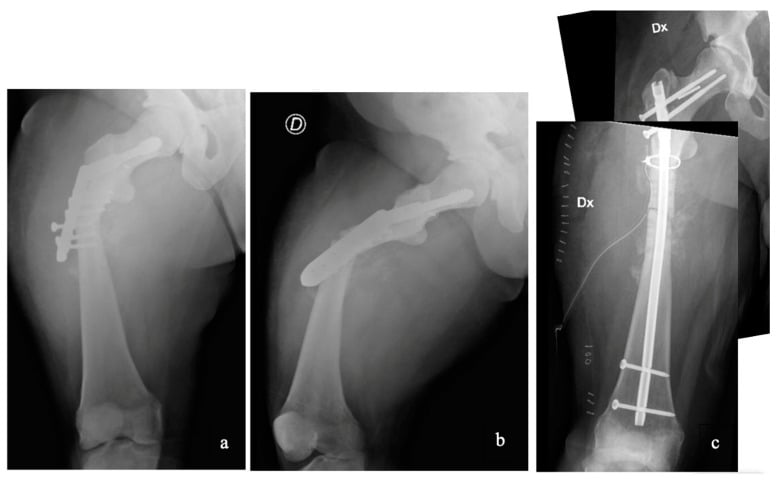Panels a and b, proximal femur with a plate; panel c, a right femur with a long intramedullary nail, a proximal cerclage wire and screws into the femoral neck