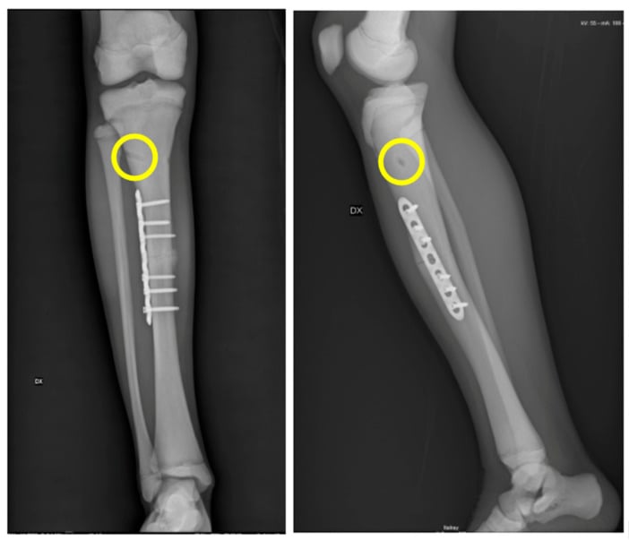 Anteroposterior and lateral radiographs of a right tibia, marked DX, after plate fixation of the shaft, with yellow circles on the proximal tibia