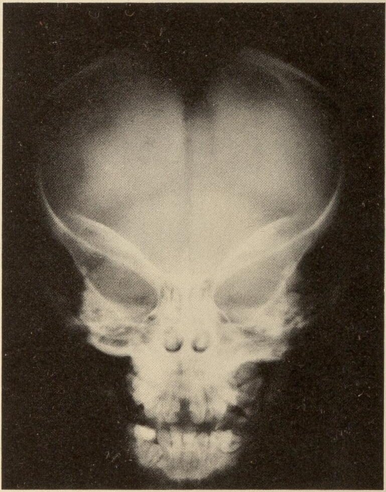 Frontal skull radiograph in pyknodysostosis showing a widely open metopic suture and frontal bossing