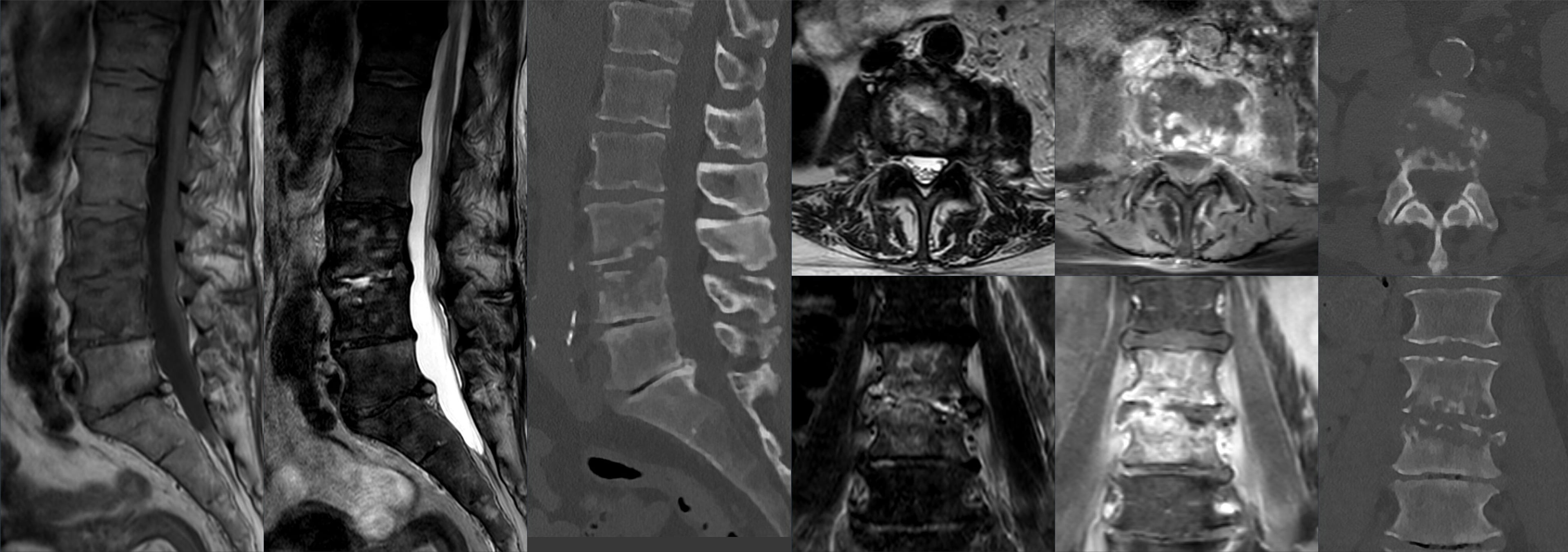Multi-sequence MRI and CT of L3/4 spondylodiscitis: sagittal T1, T2, axial and coronal T2/STIR, post-contrast T1 fat-saturated MRI, and CT bone-window images in three planes