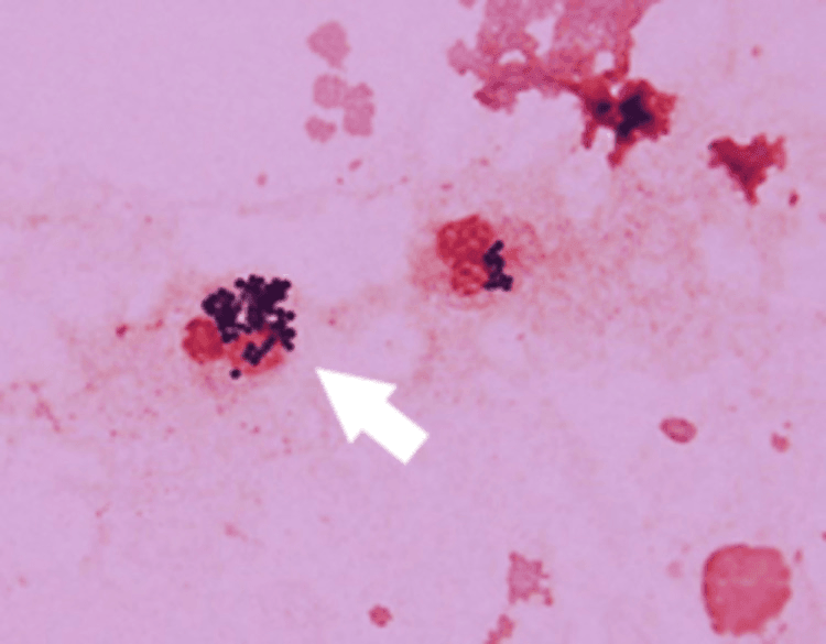 Gram stain of aspirated pus showing clusters of gram-positive cocci