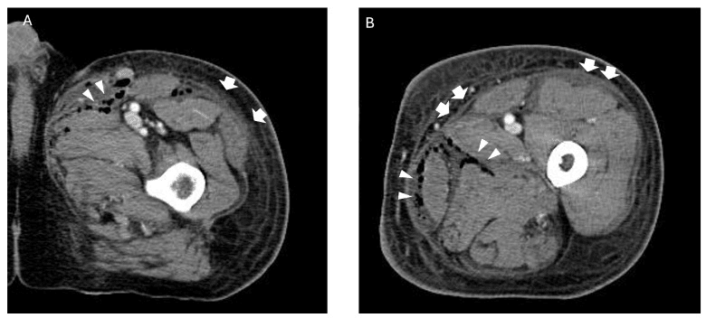 Axial CT of the lower extremity showing gas tracking along fascial planes in necrotizing fasciitis