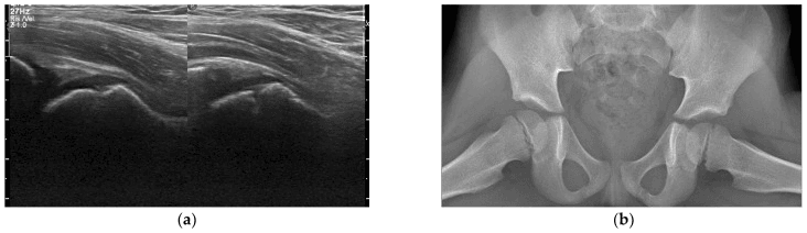 Ultrasound and hip radiograph reported normal with MRI showing obturator muscle oedema and abscess in a child with hip pain