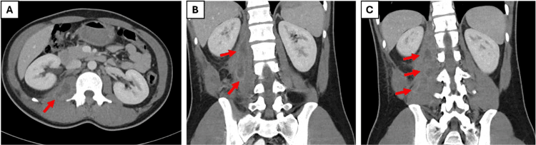 Axial and coronal contrast CT showing a multiloculated abscess tracking along the psoas into the iliacus