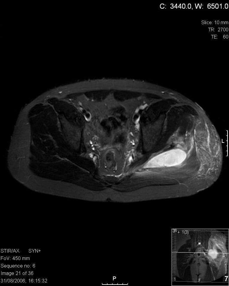 Axial STIR MRI through the pelvis showing a well-defined hyperintense fluid collection in the left gluteal muscle - a pyomyositis abscess