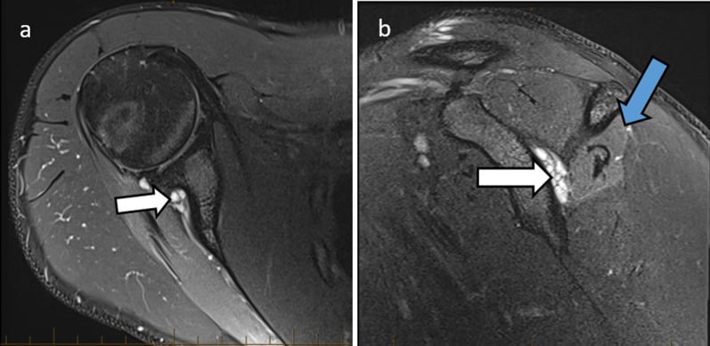Axial and sagittal fat-suppressed shoulder MRI showing a posterior labral tear with a paralabral cyst extending into the spinoglenoid notch and denervation change in infraspinatus