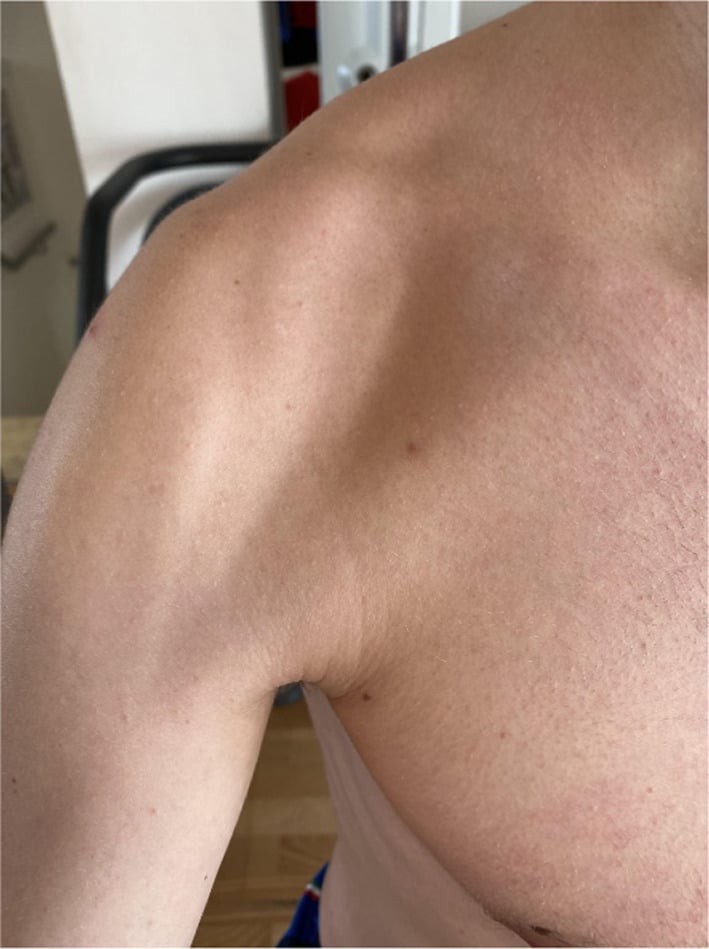Close clinical photograph of focal anterior deltoid hollowing in a young overhead athlete with neurogenic quadrilateral space syndrome