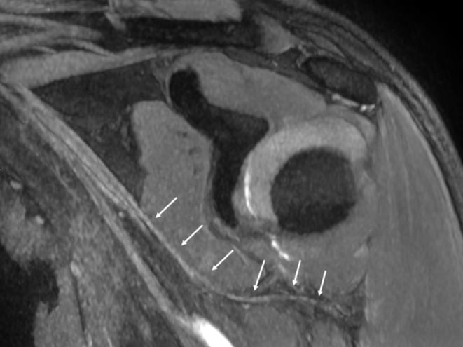 Shoulder MR neurography showing the axillary nerve coursing through the quadrangular space, marked by serial arrows