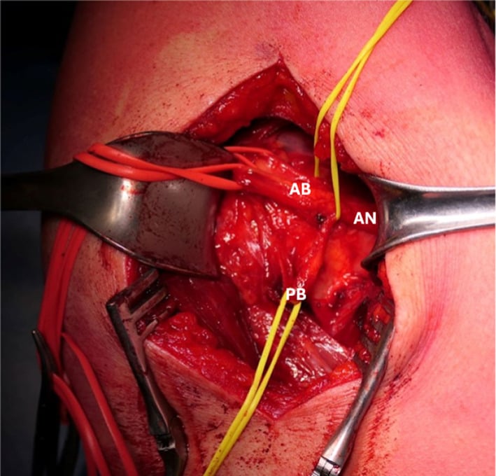 Posterior operative exposure of the quadrangular space showing the common axillary nerve branch dividing into anterior and posterior branches