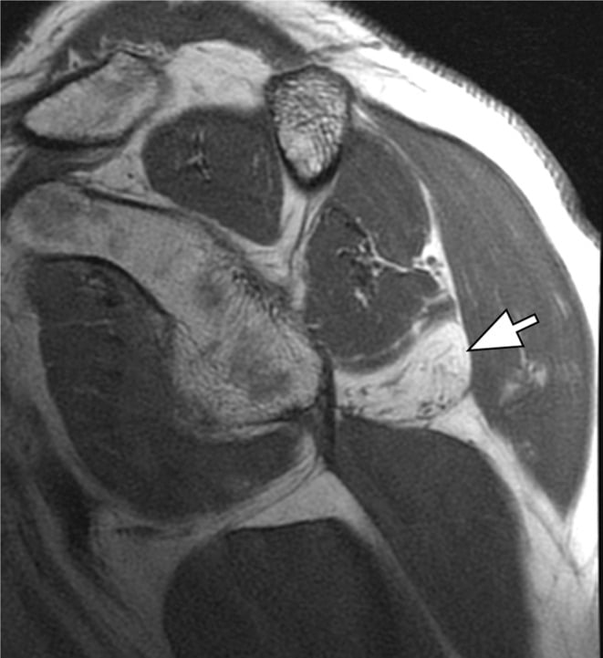 Sagittal T1-weighted shoulder MRI showing complete fatty atrophy of the teres minor muscle marked by an arrow
