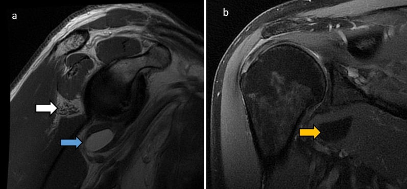 Sagittal and coronal shoulder MRI showing severe fatty atrophy of teres minor next to a lipomatous tumour