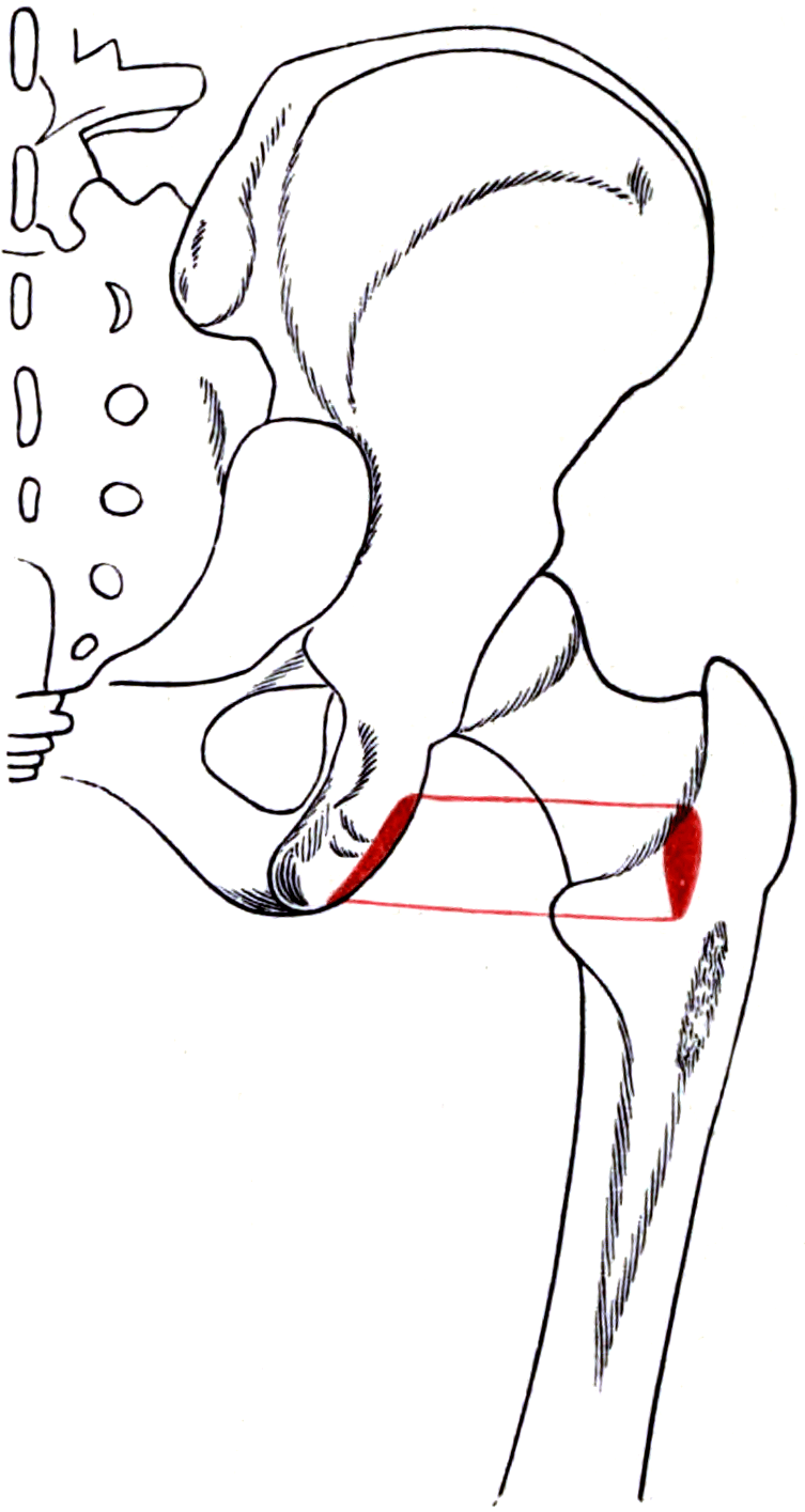 Diagram of the right hip bone and proximal femur with the outline and attachment areas of quadratus femoris shaded.