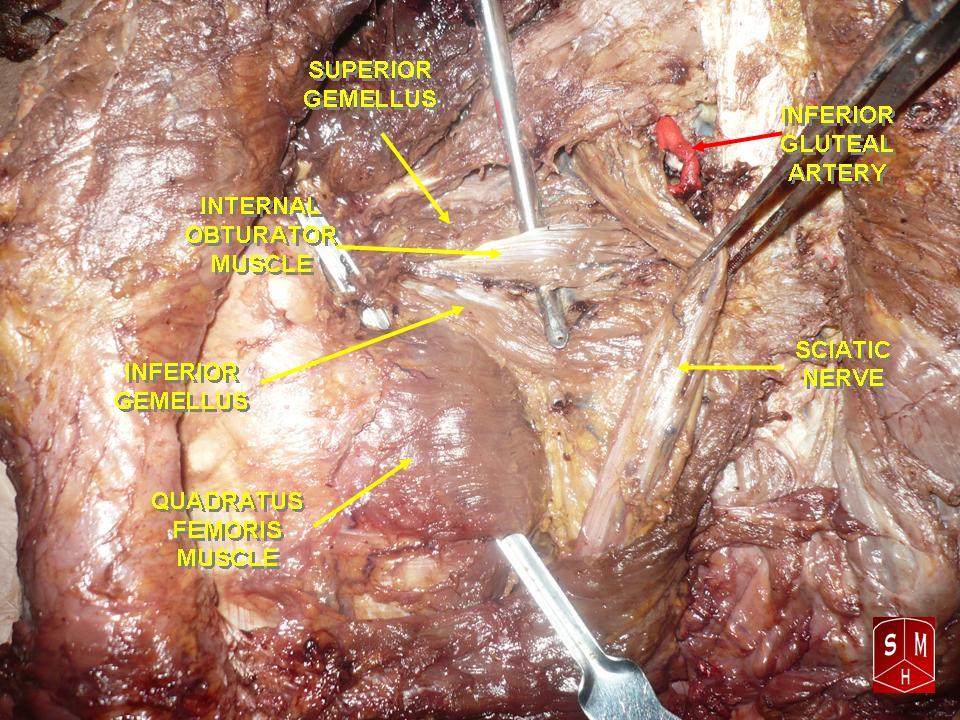 Posterior view of the gluteal region with quadratus femoris highlighted between the ischial tuberosity and the femur.