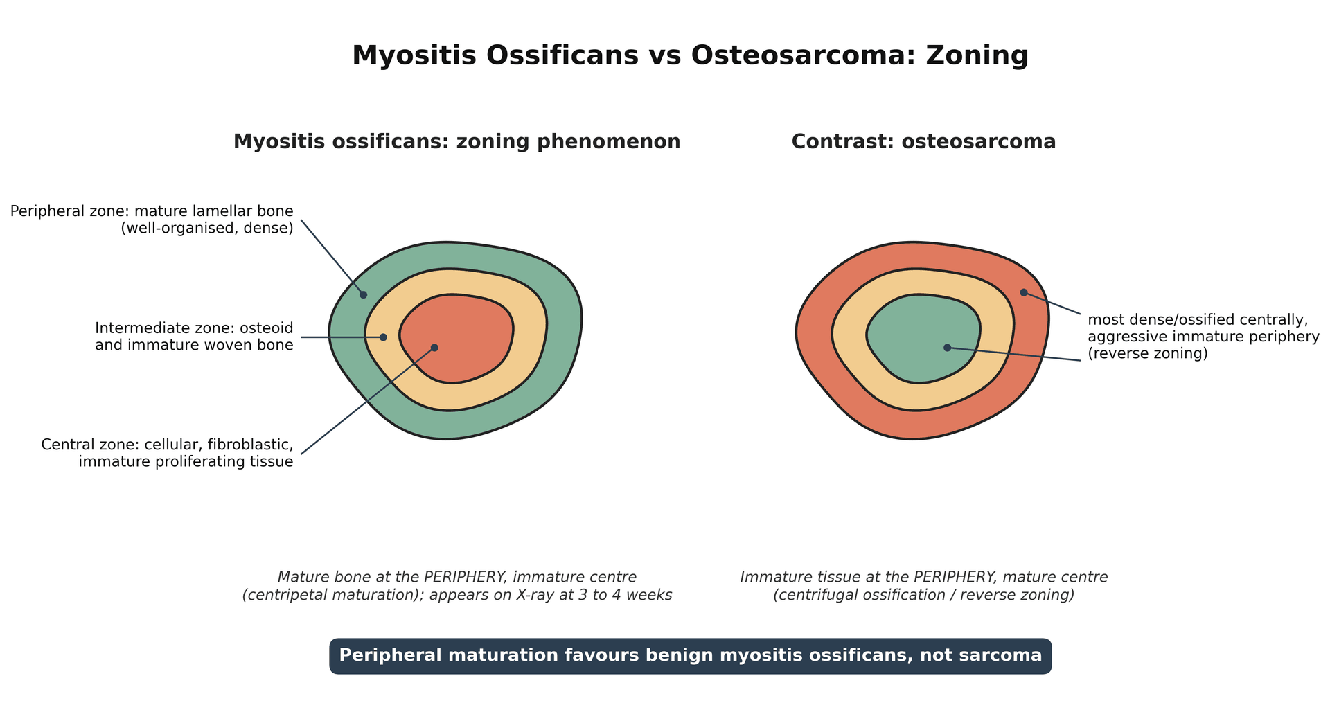 Diagram contrasting the peripheral zoning of myositis ossificans with the reverse zoning of osteosarcoma