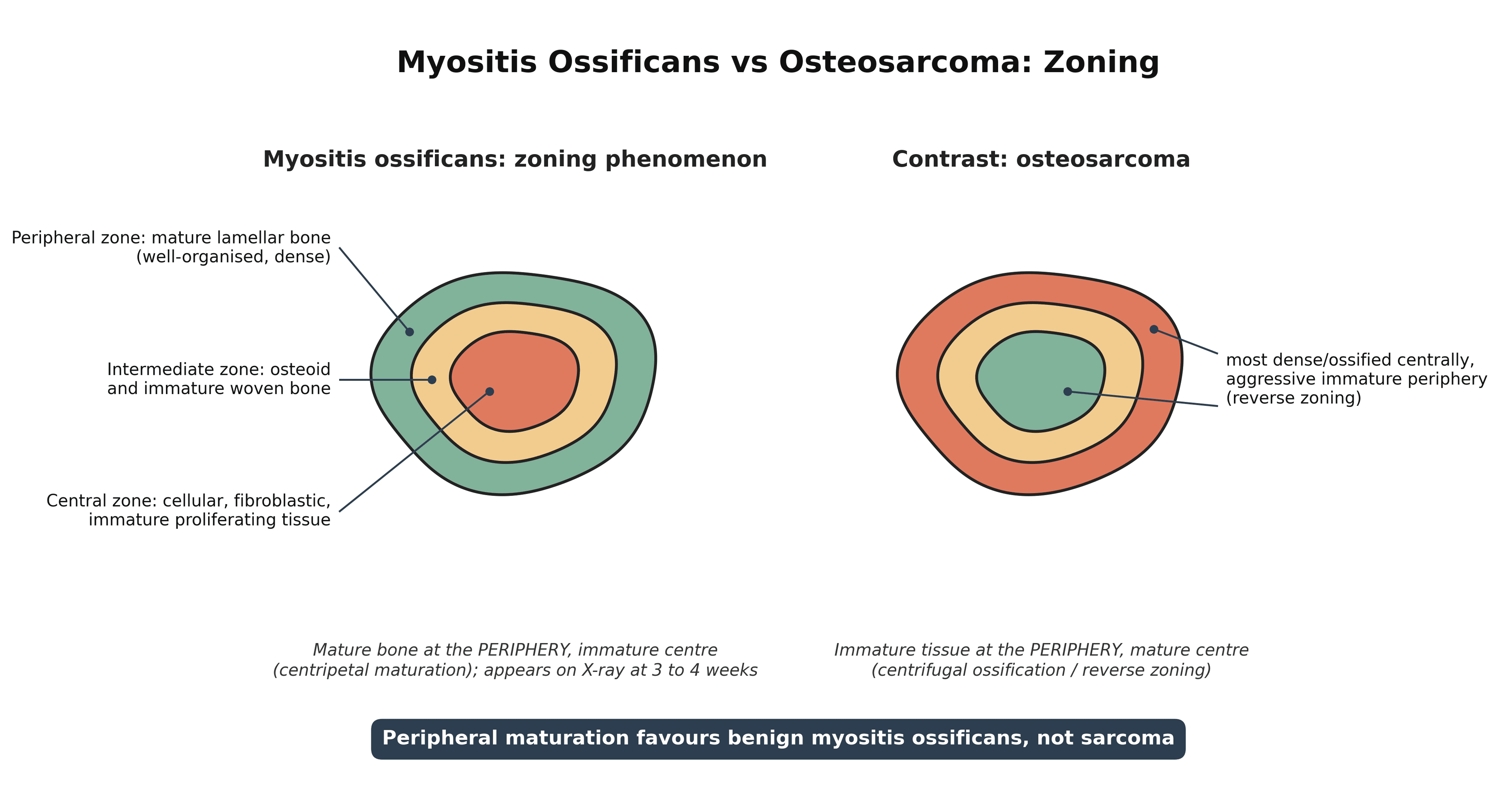 Diagram contrasting the peripheral zoning of myositis ossificans with the reverse zoning of osteosarcoma