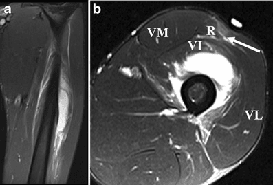 Fat-suppressed T2 MRI of an anterior thigh quadriceps contusion, coronal and axial views with the vastus muscles labelled