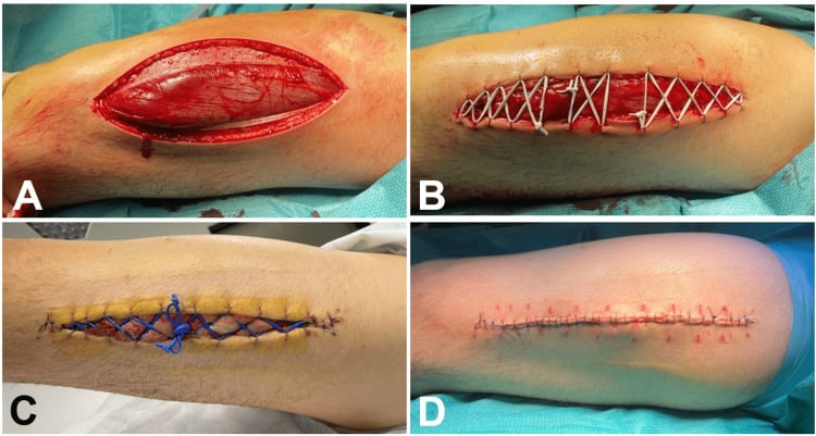Anterolateral decompressive fasciotomy with staged shoelace wound closure
