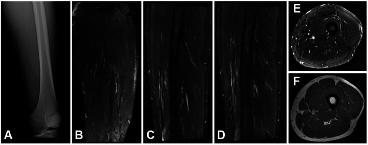 Three-month radiograph and MRI follow-up after thigh fasciotomy