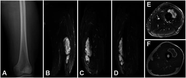 Initial radiograph and MRI STIR of a thigh contusion with a large intramuscular haematoma