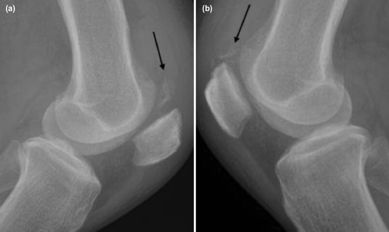Paired lateral knee radiographs showing calcification at both quadriceps tendon insertions and low-riding patellae, with arrows marking the calcified suprapatellar tendon.