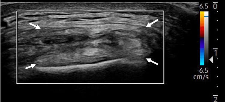 Short-axis colour Doppler ultrasound of the distal quadriceps tendon with arrows marking the tendon and no visible intratendinous vascular signal.