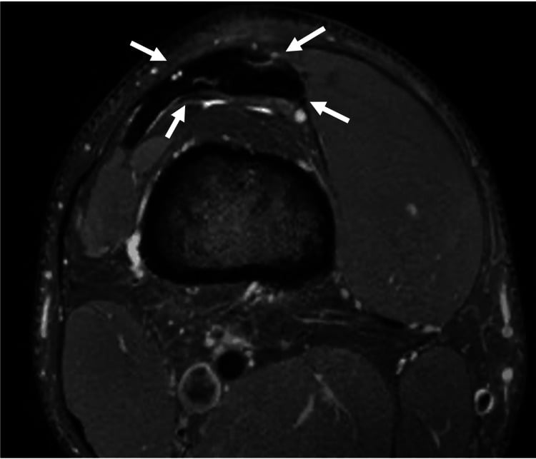Axial proton-density fat-suppressed knee MRI with arrows surrounding increased signal and thickening in the distal quadriceps tendon above the patella.