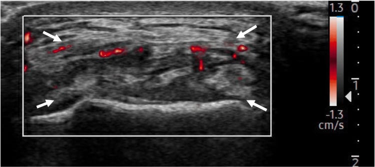 Short-axis MV-Flow ultrasound of the same distal quadriceps tendon showing multiple red low-velocity vascular signals within the tendon.
