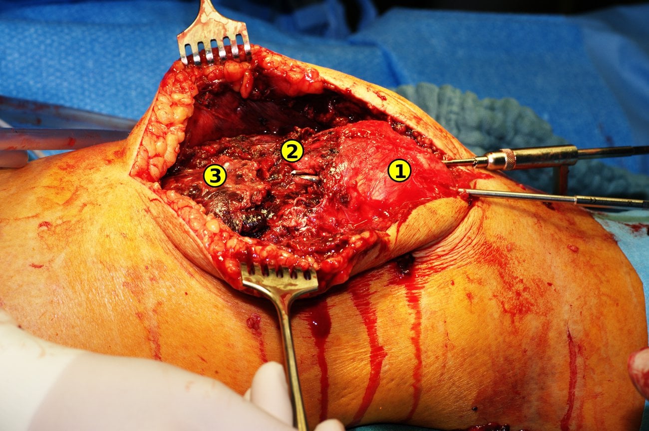 Intraoperative photograph of a quadriceps tendon rupture (the end-stage complication of tendinosis) during open repair, with patella, ruptured tendon edge and retracted proximal tendon labelled.