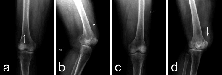 AP and lateral radiographs of both knees in bilateral quadriceps tendon rupture, arrows marking small fragments above the superior pole of the patella