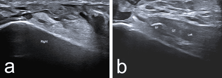 Longitudinal ultrasound of the right and left knees in bilateral quadriceps tendon rupture, with labelled bone fragments