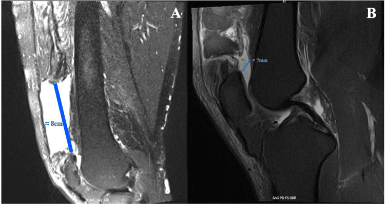MRI of chronic quadriceps tendon rupture with an 8 cm retraction gap and a 7 mm residual haematoma