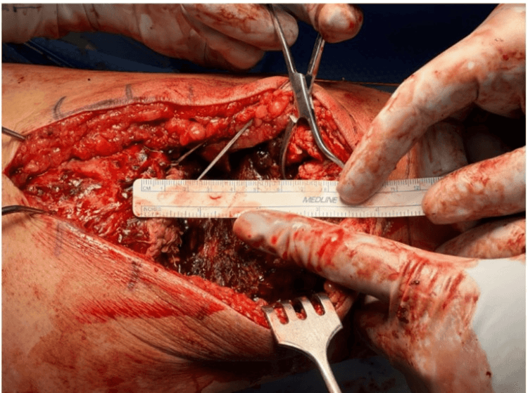 Ruler measuring a chronic quadriceps tendon retraction gap at operation