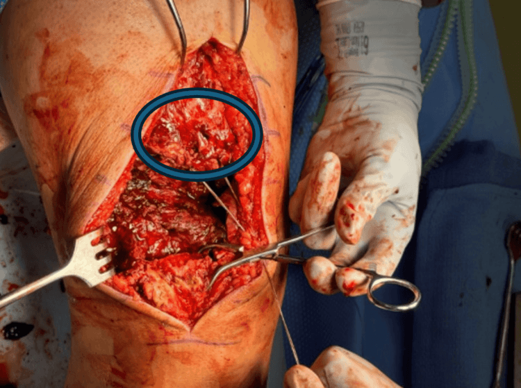 Open view of a scarred chronic quadriceps tendon stump, circled