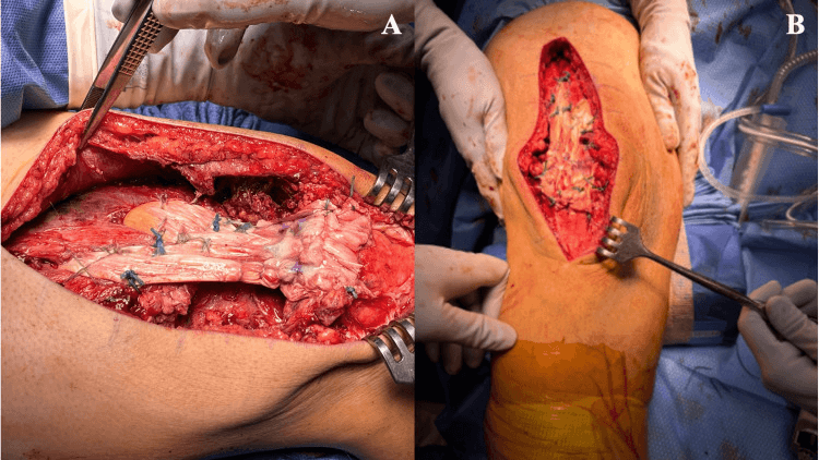 Dual Achilles allograft reconstruction of chronic quadriceps tendon rupture