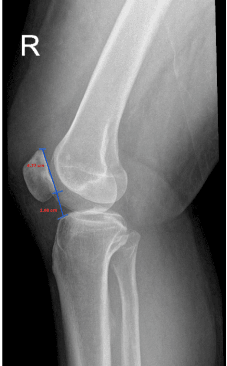 Lateral knee radiograph marked R with Caton-Deschamps measurements of 4.77 cm and 2.68 cm showing patella baja in chronic quadriceps rupture
