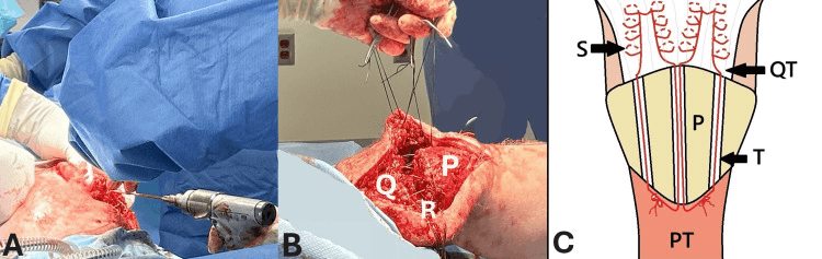 Drilling of patellar tunnels, sutures through quadriceps tendon and patella, and a schematic of locking sutures passed through patellar tunnels