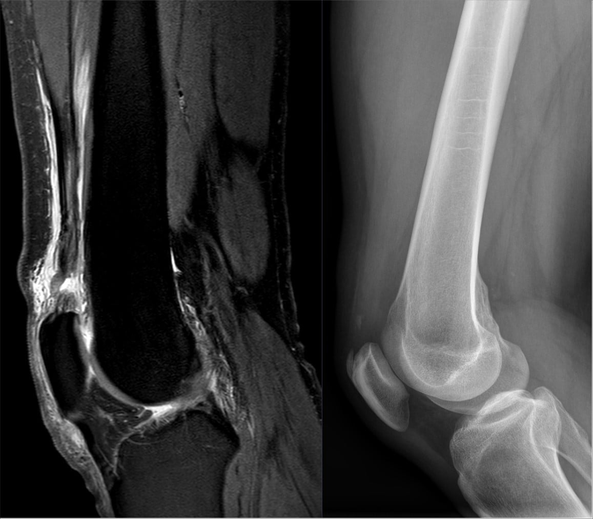 Sagittal proton-density MRI and lateral knee radiograph in a 54-year-old man with traumatic quadriceps tendon rupture.