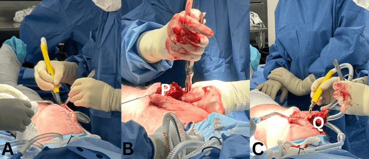 Revision quadriceps tendon exposure, superior patellar preparation and debridement of the tendon edge