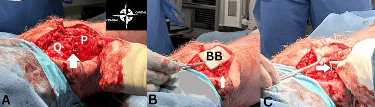 Revision quadriceps tendon repair with a bioinductive scaffold placed and fixed over the repair