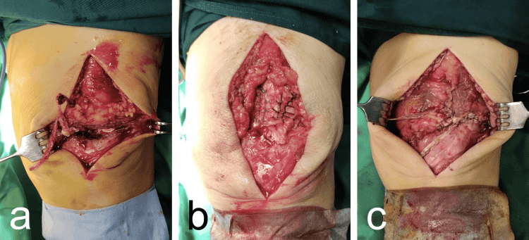 Open quadriceps tendon avulsion and transosseous repair in three operative views