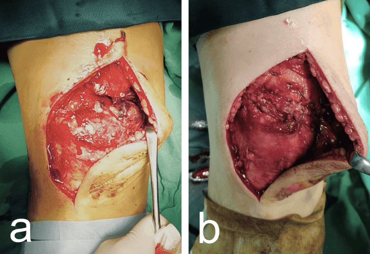 Open quadriceps tendon avulsion before and after transosseous repair
