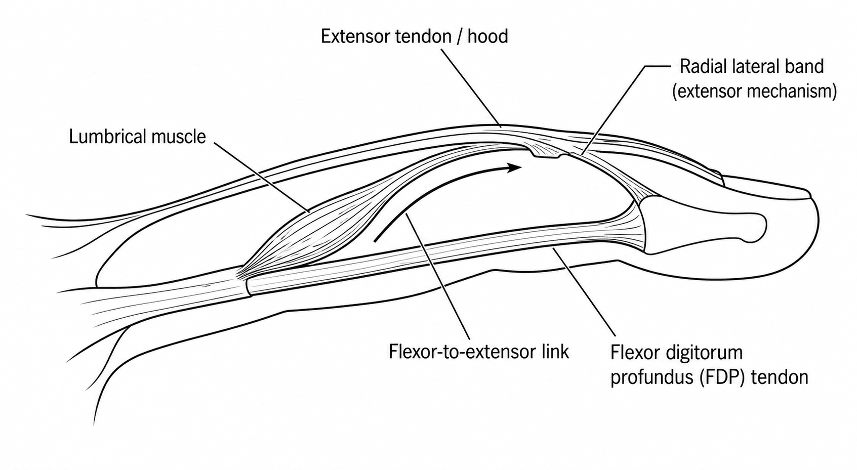 Diagram of the lumbrical muscle originating from the FDP tendon and inserting into the radial lateral band of the extensor mechanism