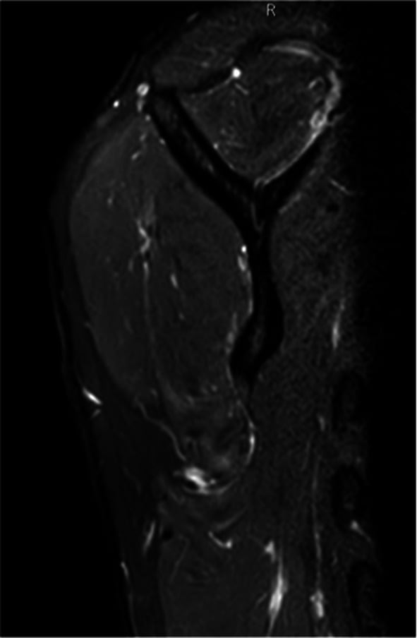MRI showing oedema and atrophy of teres minor in QSS