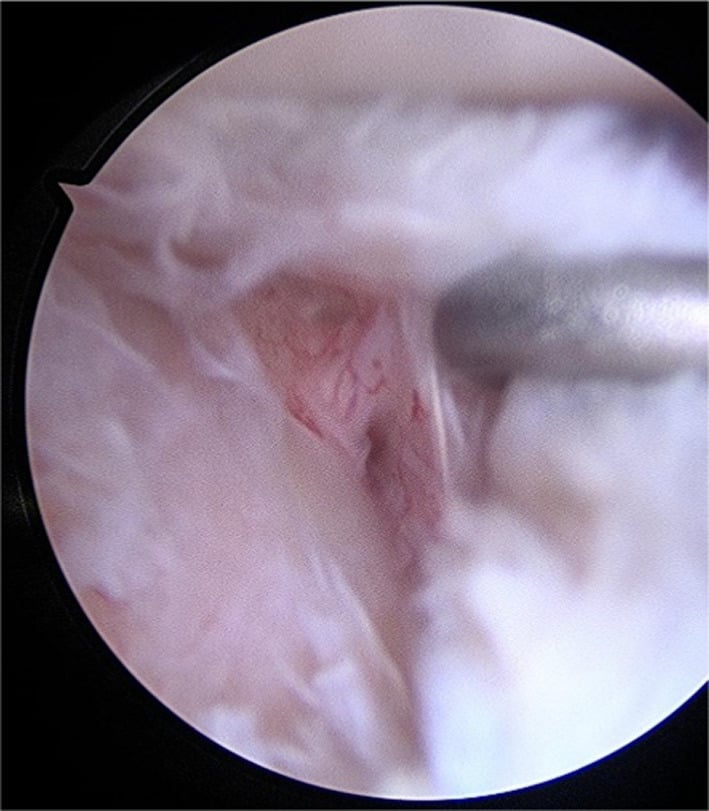 Arthroscopic posterior labral peel-back lesion