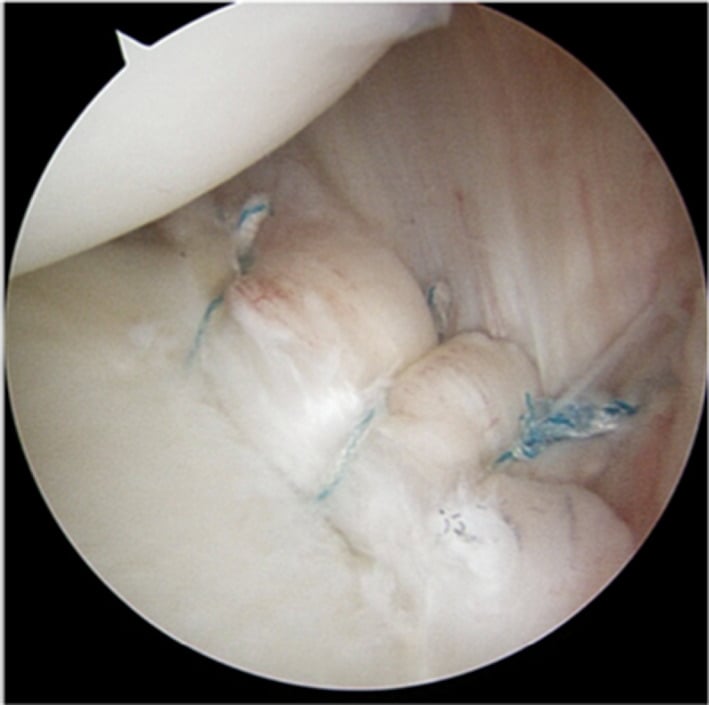 Anchor repair of a posterior labral peel-back lesion