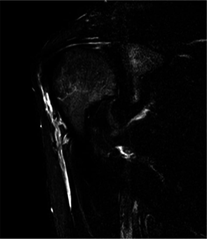 MRI showing anterior deltoid atrophy from axillary neuropathy